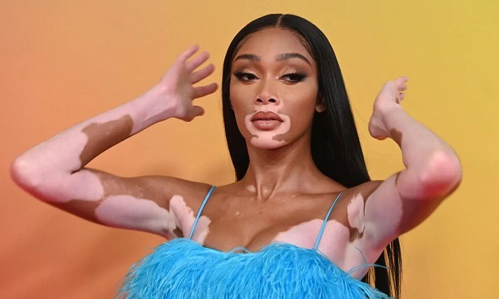 What is Winnie Harlow Net Worth, Age, Height & Weight